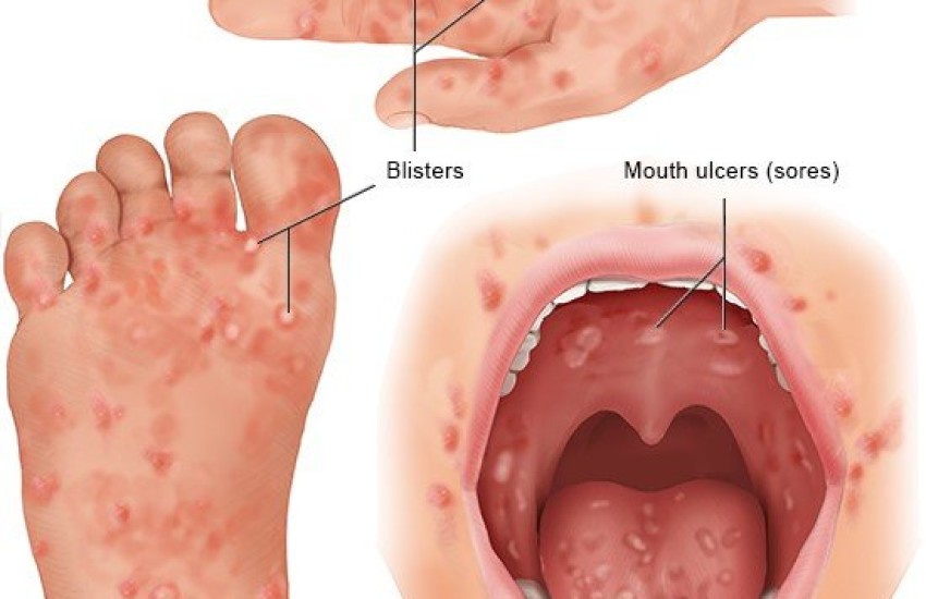 Hand Foot And Mouth Cases Rising- 66 Cases Recorded